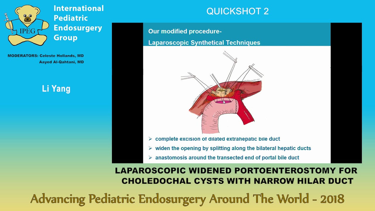 LAPAROSCOPIC WIDENED PORTOENTEROSTOMY FOR CHOLEDOCHAL CYSTS WITH NARROW ...